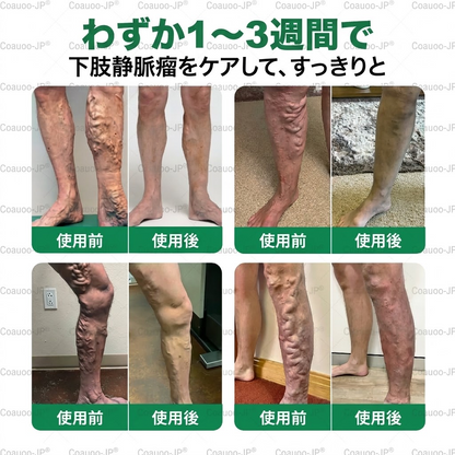 👨‍⚕️✅✅𝐂𝐨𝐚𝐮𝐨𝐨® 静脈ターゲット「コアウォー ® ヴェインターゲット」・マイクロニードルパッチ⚡即効ケア＆長期サポート ビッグセール